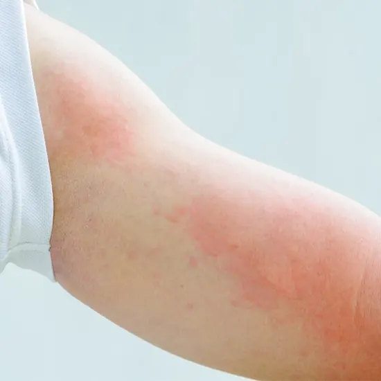Allergy: Eczema Panel for Vegetarian